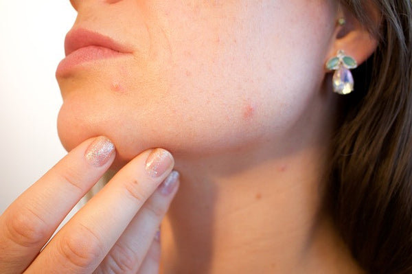 Tea Tree Oil for Acne